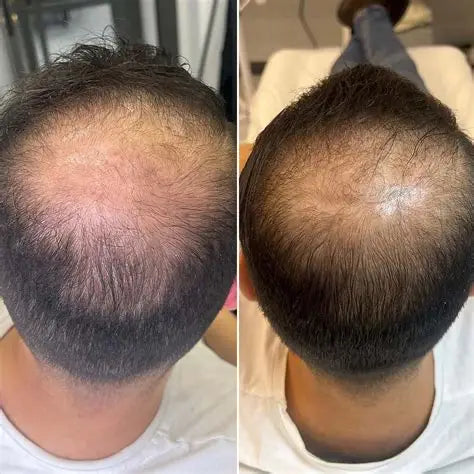 Derma Roller 0.5